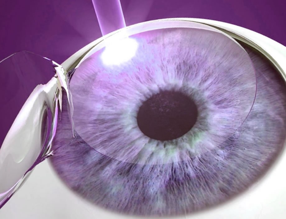 cirurgia refrativa é segura?