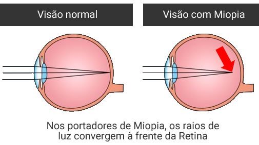 tratamento de miopia em curitiba
