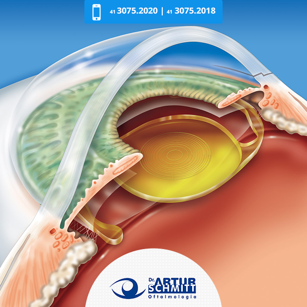 Lente multifocal para Catarata em Curitiba
