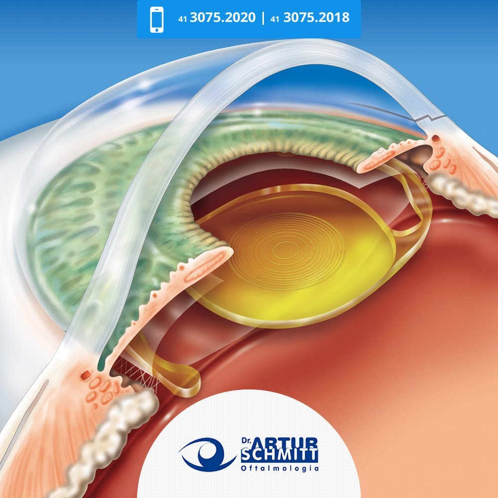 cirurgia-para-os-olhos