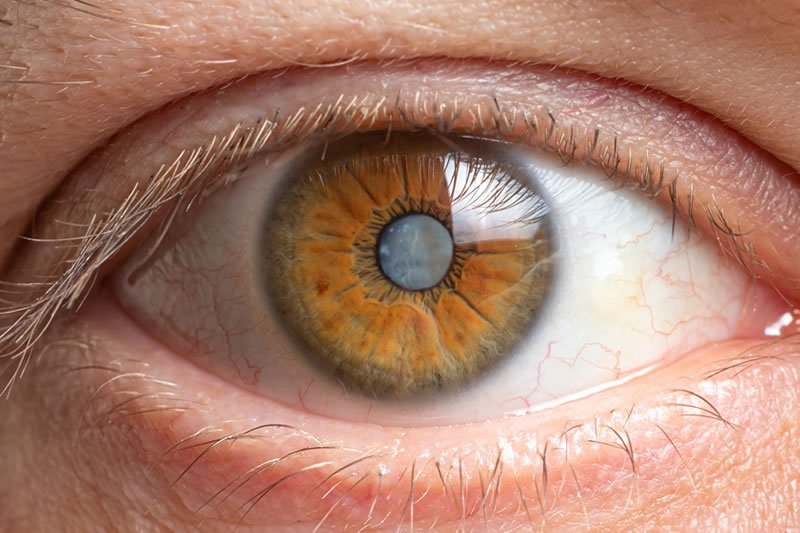 cirurgia de catarata em curitiba lentes intraoculares