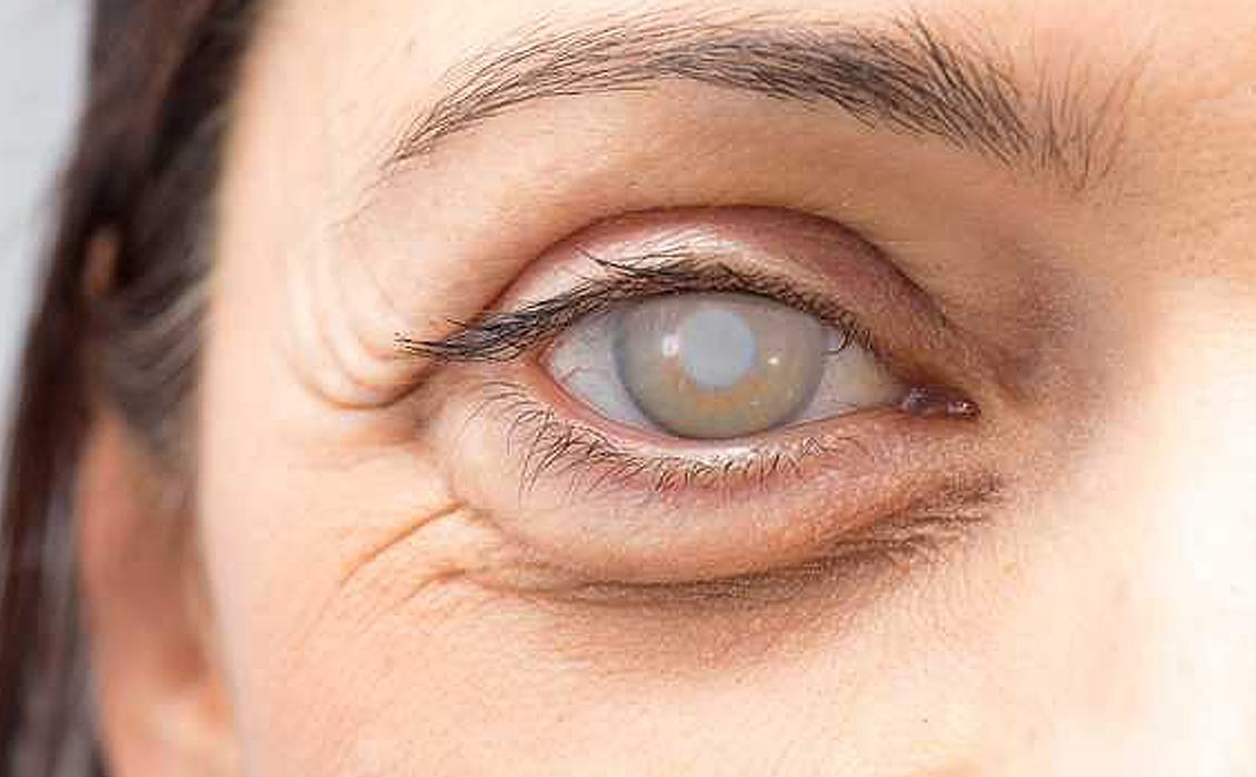 cirurgia de catarata: preço, tratamento, diagnóstico, causas e sintomas