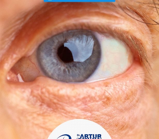 cirurgia-de-catarata-em-curitiba-2