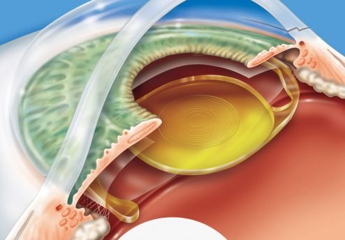 cirurgia-para-os-olhos-2