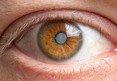 cirurgia de catarata em curitiba lentes intraoculares