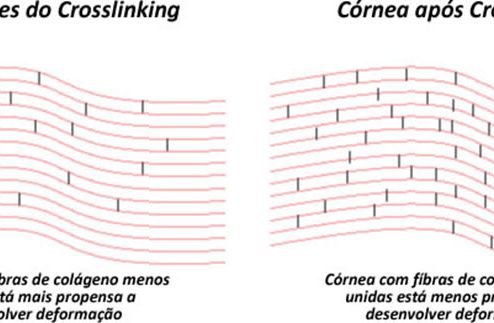 crosslinking-para-ceratocone-2