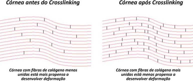 crosslinking-para-ceratocone-2