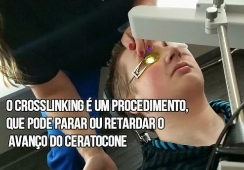 crosslinking-para-ceratocone-em-curitiba-2
