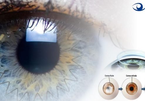 transplante-de-cornea-e-crosslinking-para-ceratocone-2