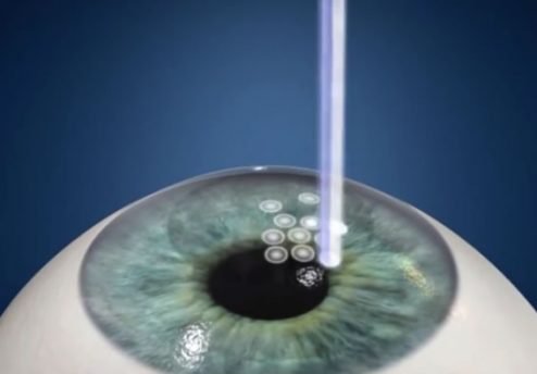 cirurgia refrativa prk curitiba