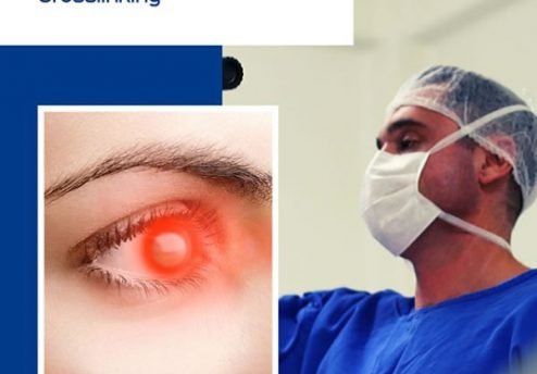 crosslinking para Ceratocone em Curitiba