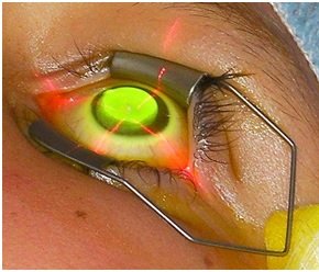crosslinking para tratamento de ceratocone em curitiba