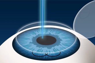 lasik curitiba cirurgia para correção de erros refrativos