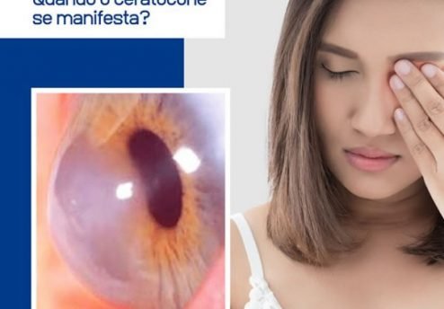quando o ceratocone se manifesta