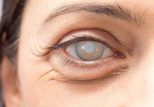 cirurgia de catarata: preço, tratamento, diagnóstico, causas e sintomas